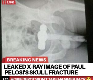 Read more about the article leaked x-ray image